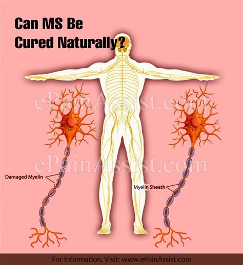 Can Ms Be Cured Reddit
