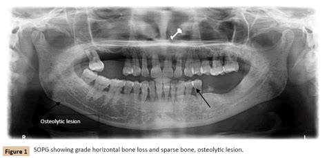 can multiple myeloma affect your teeth