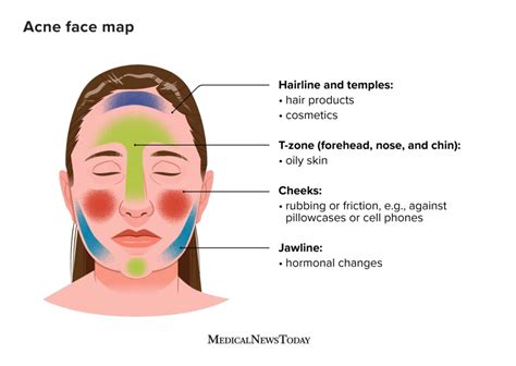 Can Narcotics Cause Acne