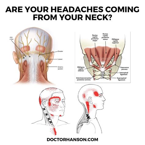 Can Neck Problems Cause Constant Headaches