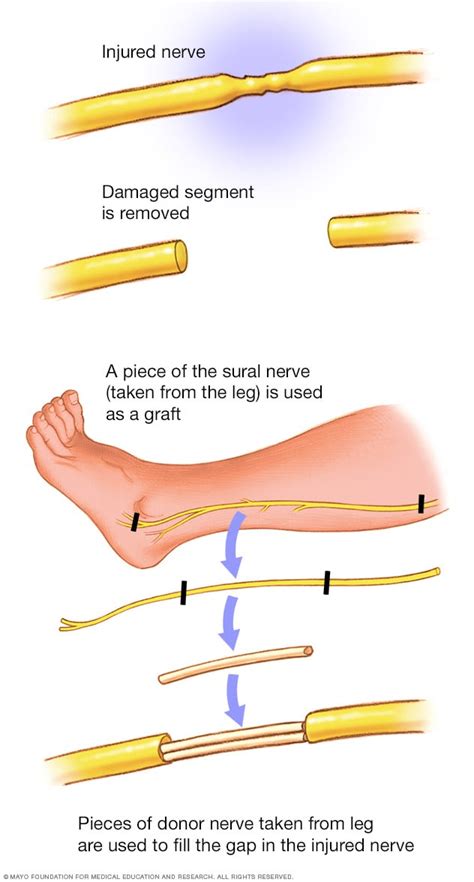 Can Nerve Damage From Surgery Be Repaired