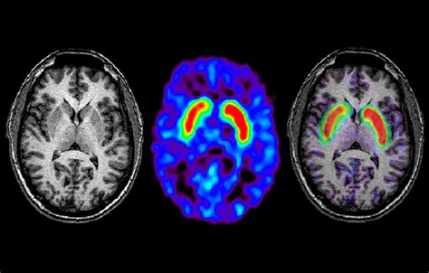 can parkinson's be seen on mri