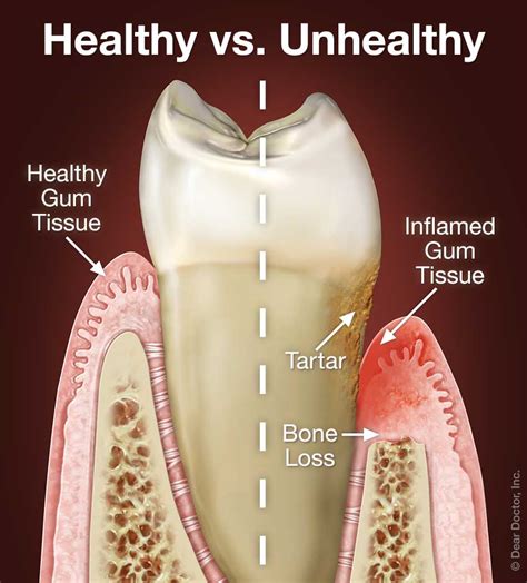 can periodontal disease be cured