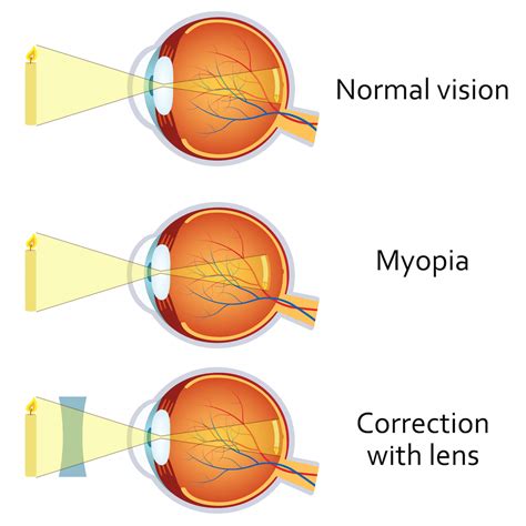 can peripheral vision be corrected