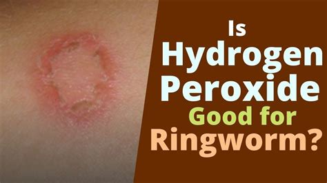 Can Peroxide Kill Ringworm