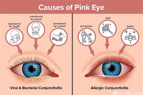 can pink eye spread from one eye to the other
