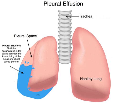 Can Pleural Effusion Be Fatal