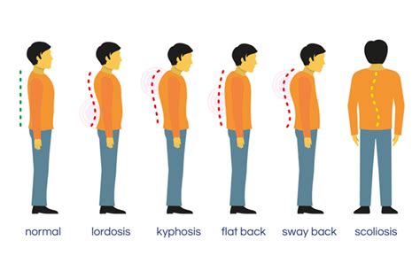 Can Poor Posture Be Reversed