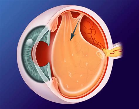 can posterior vitreous detachment be fixed