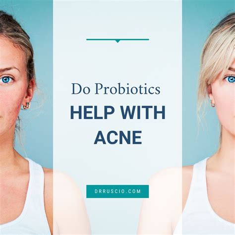 Can Probiotics Help with Acne? Exploring the Potential Benefits