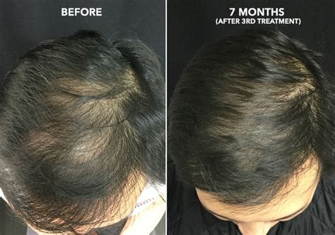 Can Prp Regrow Hair  The Truth Revealed