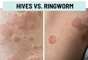 Can Ringworm Cause Hives
