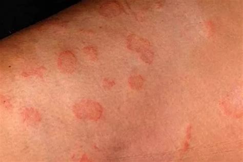 Can Ringworm Spread On Surfaces