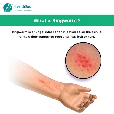 Can Ringworm Spread On Your Clothes