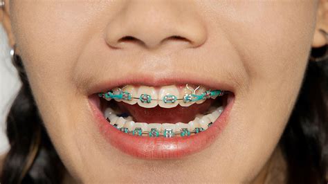 Can Rubber Bands Pull Teeth Together