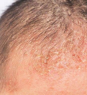 can seborrheic dermatitis last for years