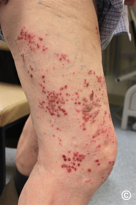 can shingles form on buttocks