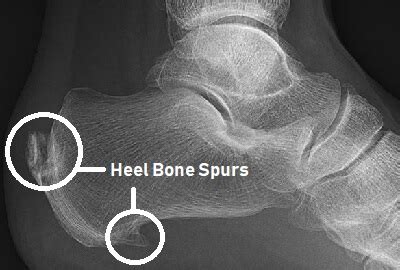 can shoes cause bone spurs