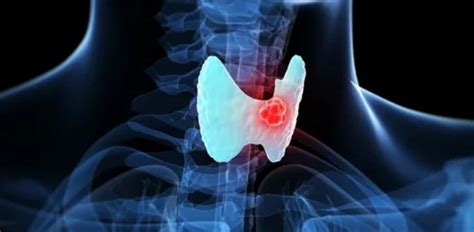 can smoking cause thyroid cancer