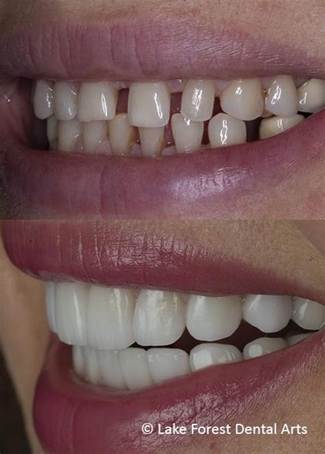 can spaces between teeth be filled