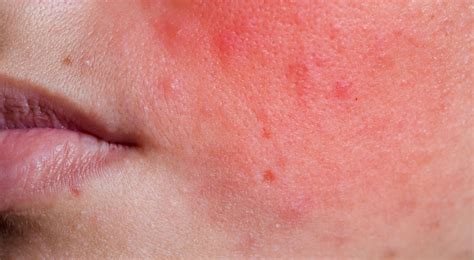 can stomach problems cause face rashes