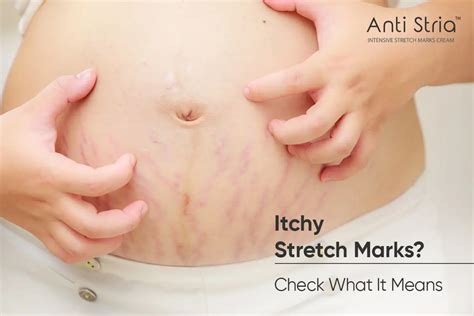 can stretch marks itch