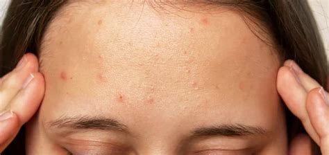 Can Sweating Cause Breakouts