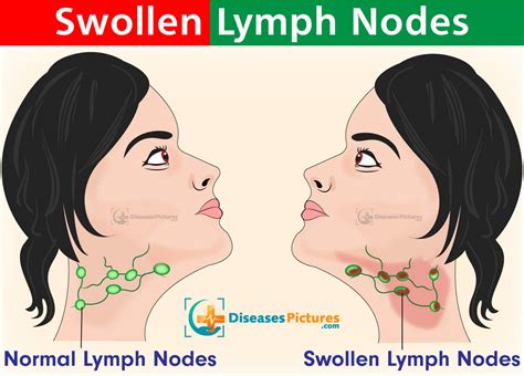 can swollen lymph nodes be cause by stress