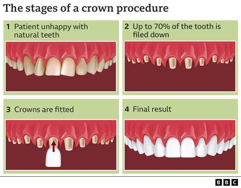 Can Teeth Be Filed Down Uk
