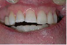 Can Teeth Be Lengthened