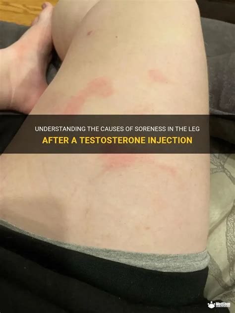 Can Testosterone Cause Leg Swelling