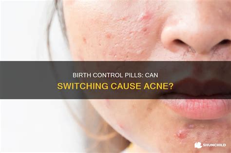 Can The Birth Control Patch Cause Acne