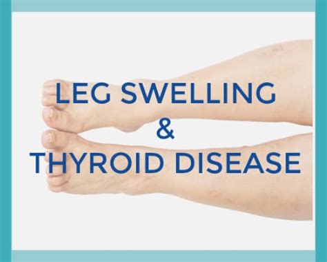can thyroid problems cause edema