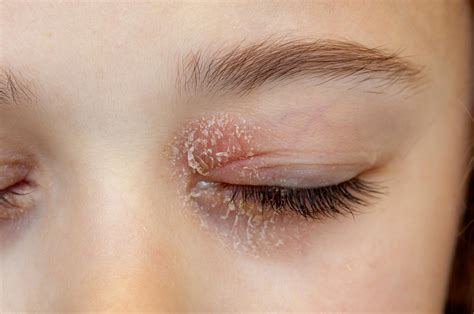 can u get eczema on your eyelids