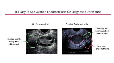 can ultrasound show endometriosis