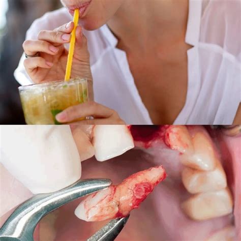 Can Use Straw After Tooth Extraction