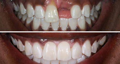 Can Veneers Replace Missing Teeth