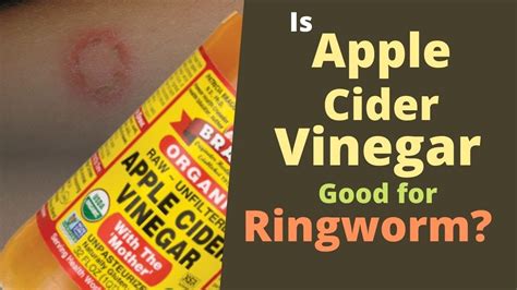 Can Vinegar Kill Ringworm