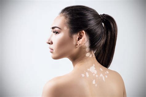 can vitiligo be cured completely