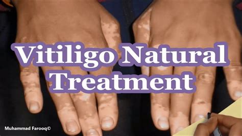 can vitiligo be cured permanently