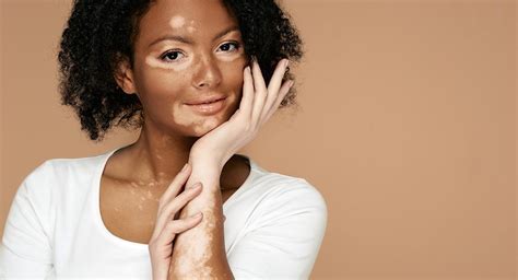 can vitiligo be treated