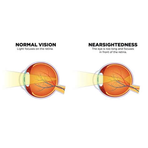 can vitreous detachment cause blurred vision