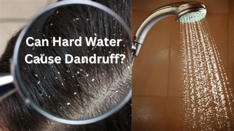 Can Water Help With Dandruff