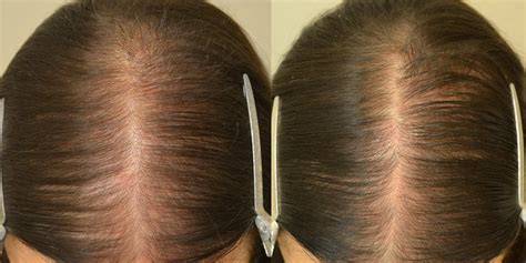 can women take finasteride for hair loss