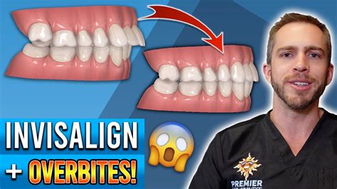 can you correct overbite with invisalign