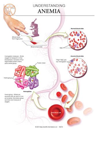 can you develop anemia suddenly