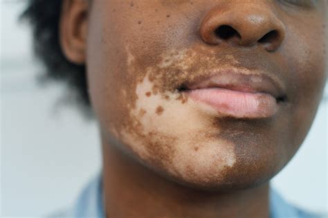 can you develop vitiligo later in life