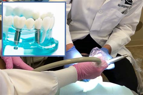 Unique Can You Fix A Loose Dental Implant Trend This Years