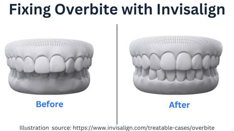 can you fix overbite with invisalign