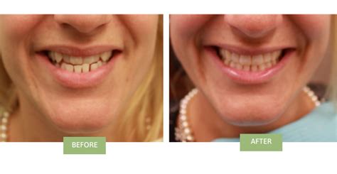 can you fix underbite with invisalign